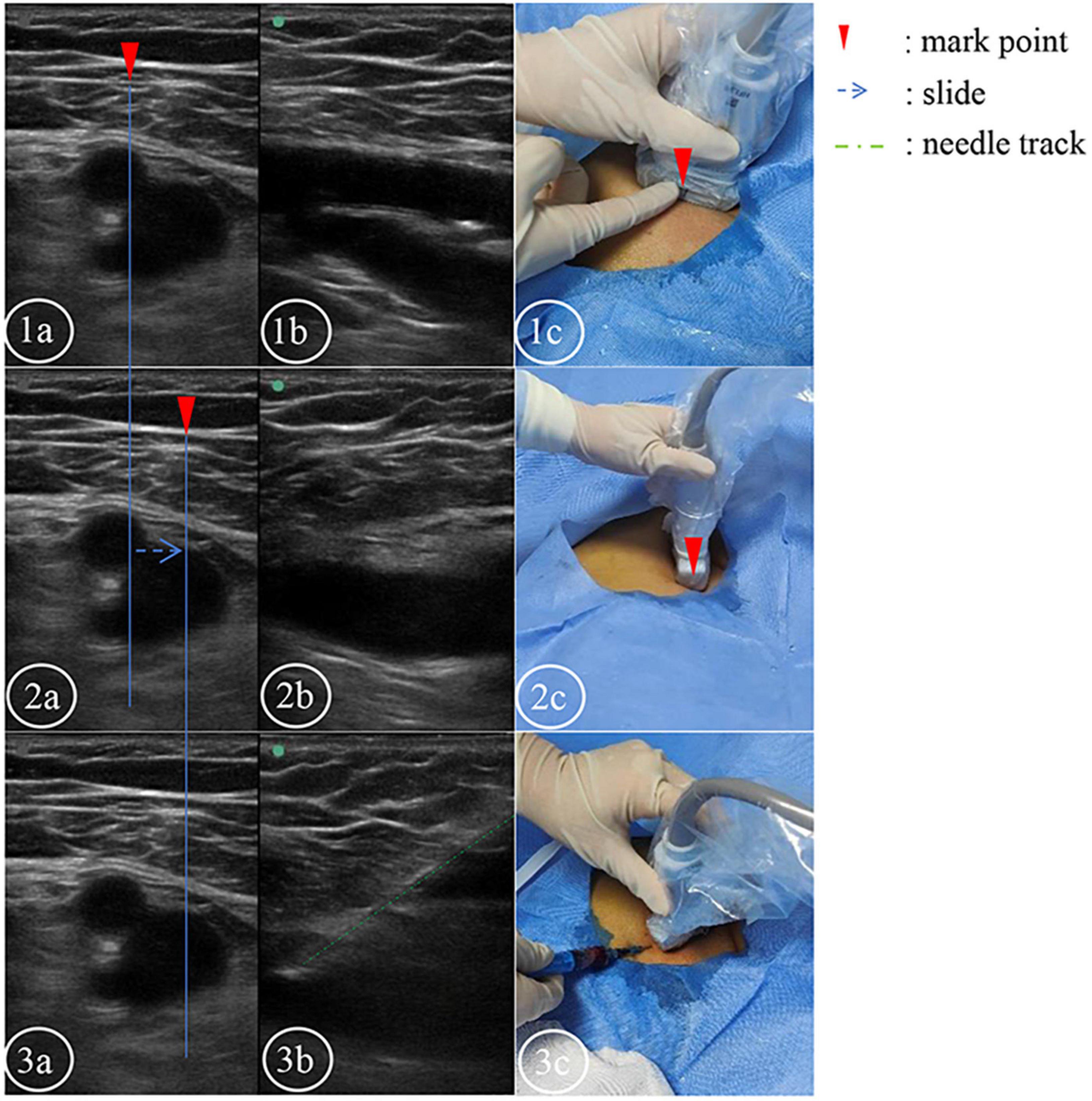 Application of the ultrasound-guided double-screen contrast method in the standardized teaching and training of resident doctors in femoral vein puncture